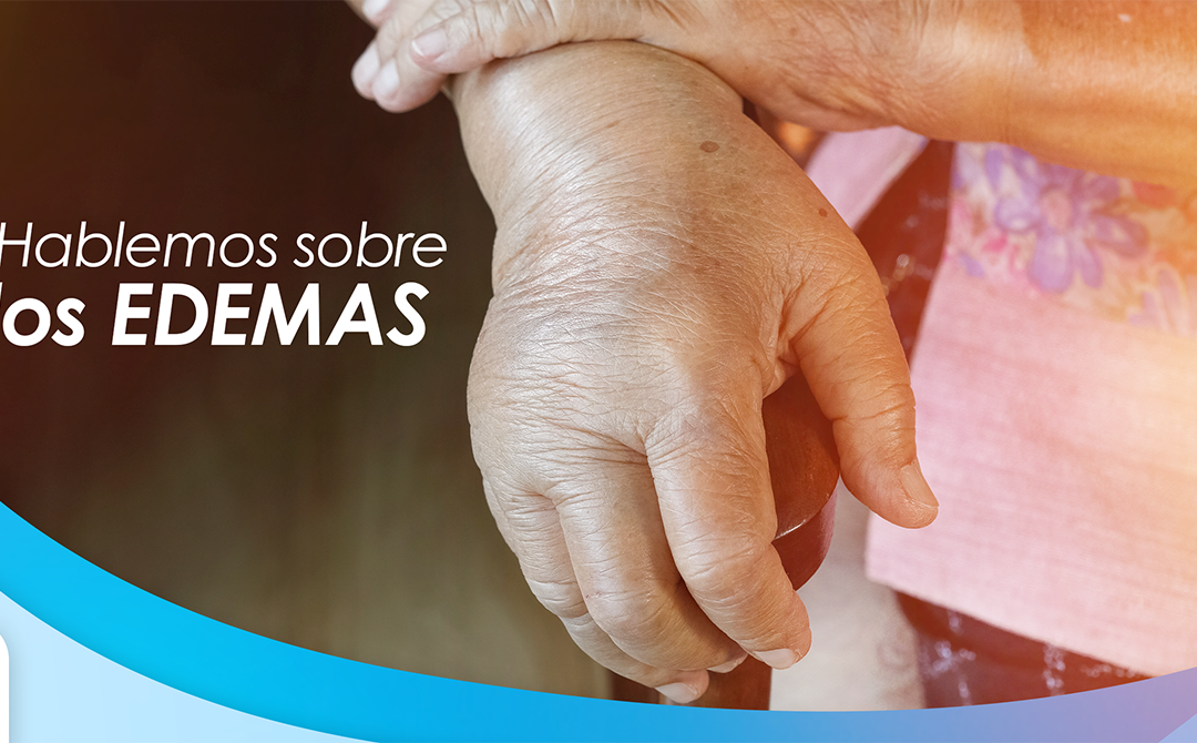 Edemas en pacientes con diabetes y/o amputados: ¿es normal?