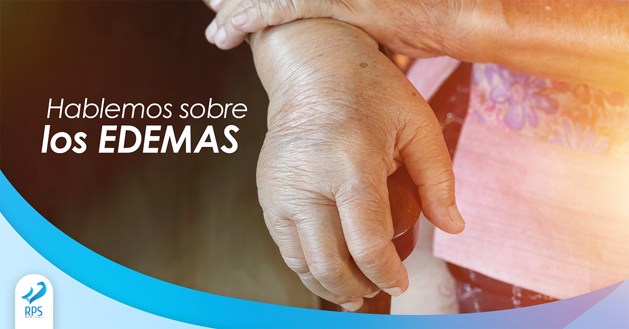 Edemas en pacientes con diabetes y/o amputados: ¿es normal?